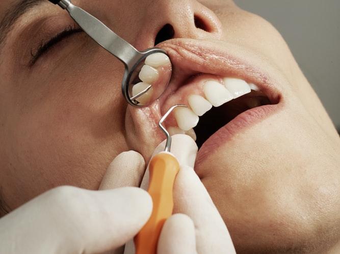 This image shows a person's teeth being cleaned during a dentist appointment.